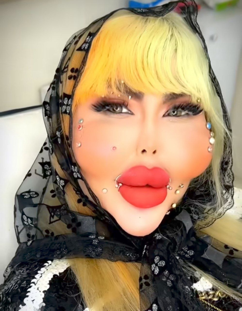 عکس آناهیتا ناچو قبل از عمل